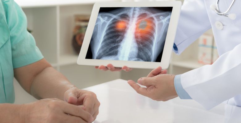 Combinação de TKi e quimioterapia aumenta sobrevivência no CPNPC EGFR+